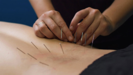 dry-needling